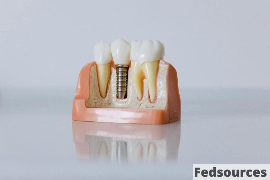 Detailed dental implant model showcasing teeth structure for educational purposes.