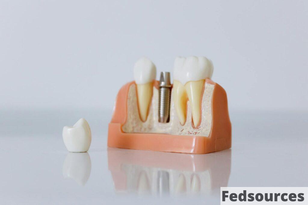 Close-up of a dental implant model featuring artificial teeth and jaw structure.